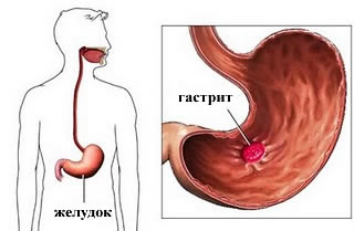 Лечение гастрита в Израиле