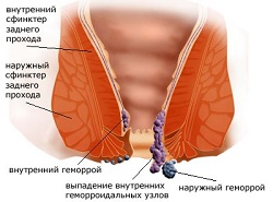 Лечение геморроя в Израиле.