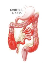 Лечение болезни Крона в Израиле.