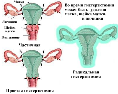 Гистерэктомия в Израиле